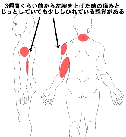 腕の痛みとしびれの症例 その7 和歌山の整体 医療関係者や専門家も絶賛 廣井整体院