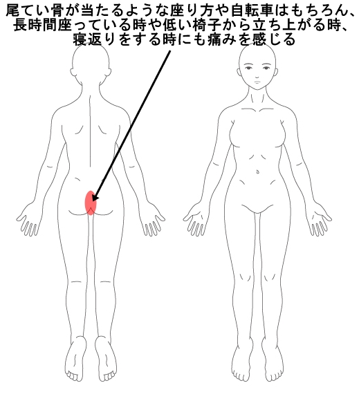 尾てい骨の痛みの症例 その3 和歌山の整体 医療関係者や専門家も絶賛 廣井整体院