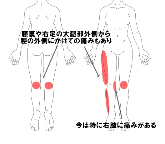 変形性膝関節症の症例 その6 和歌山の整体 医療関係者や専門家も絶賛 廣井整体院